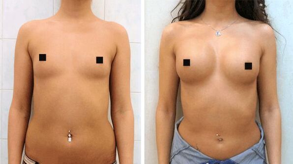 fotografii înainte și după mărirea chirurgicală a sânilor