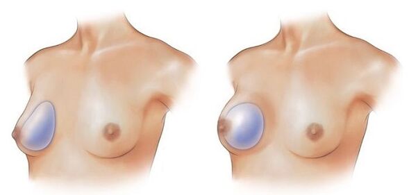 implanturi în formă de picătură și rotunde pentru mărirea sânilor