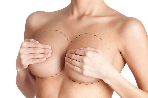 markup pentru operația de mărire a sânilor