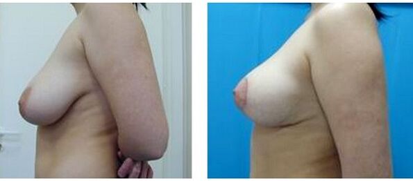 înainte și după mărirea chirurgicală a sânilor