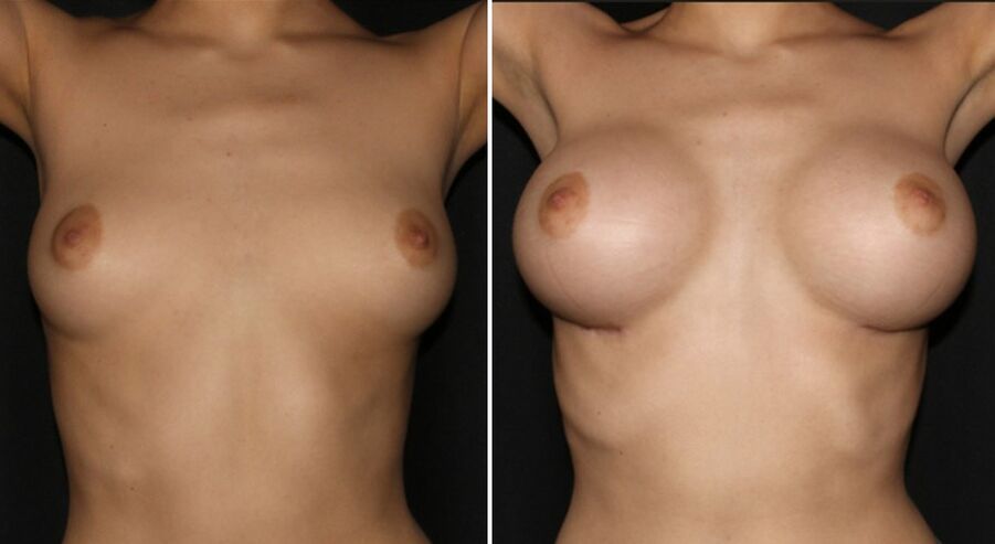 Înainte și după operația de mărire a sânilor